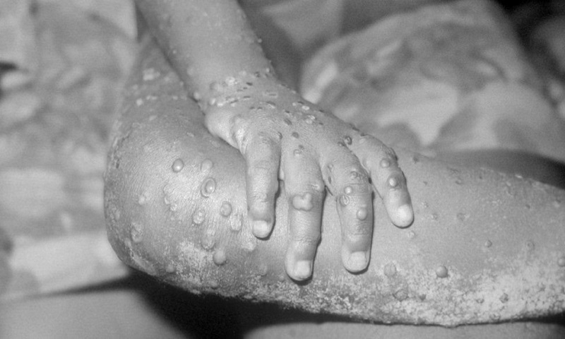 monkeypox