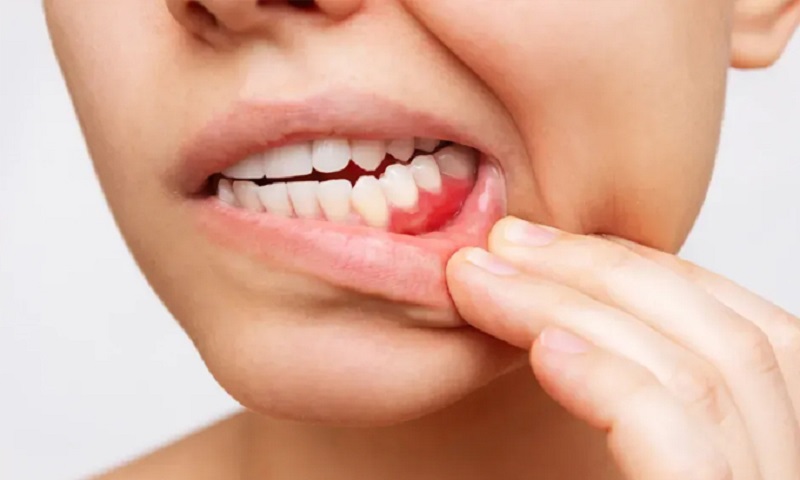 oral-cancer